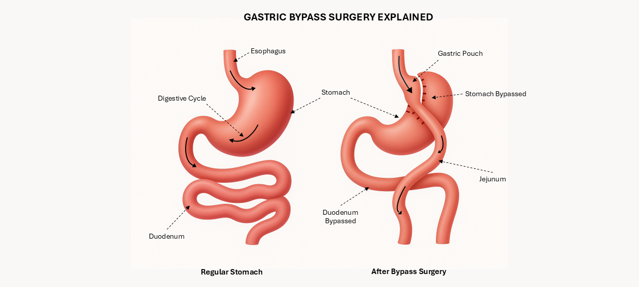 Gastric Bypass Surgery explained-Reem Hospital Abu Dhabi