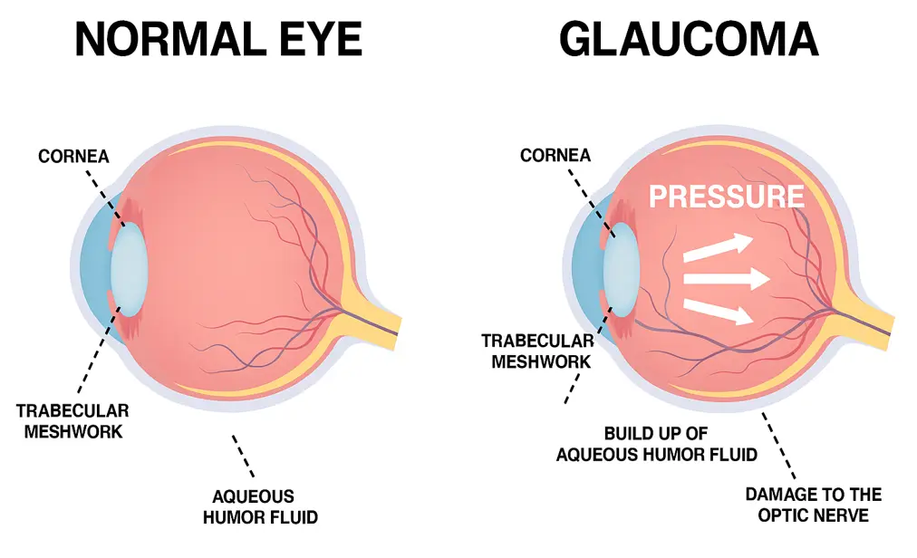 Glaucoma treatment in Abu Dhabi | Reem Hospital علاج الجلوكوما في أبوظبي | مستشفى الريم